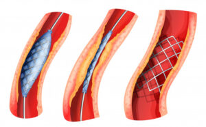 What is the Value of Absorbable Heart Stent Market in 2021