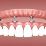 The Advantages of Snap-in Dentures Over Traditional Dentures